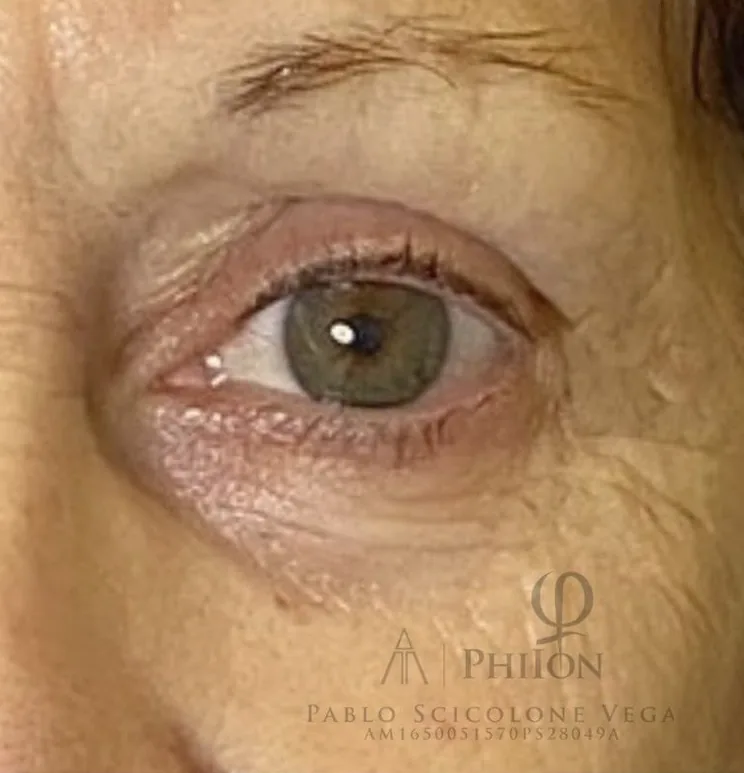 Blefaroplastia sin cirugía — caso real 3 — después