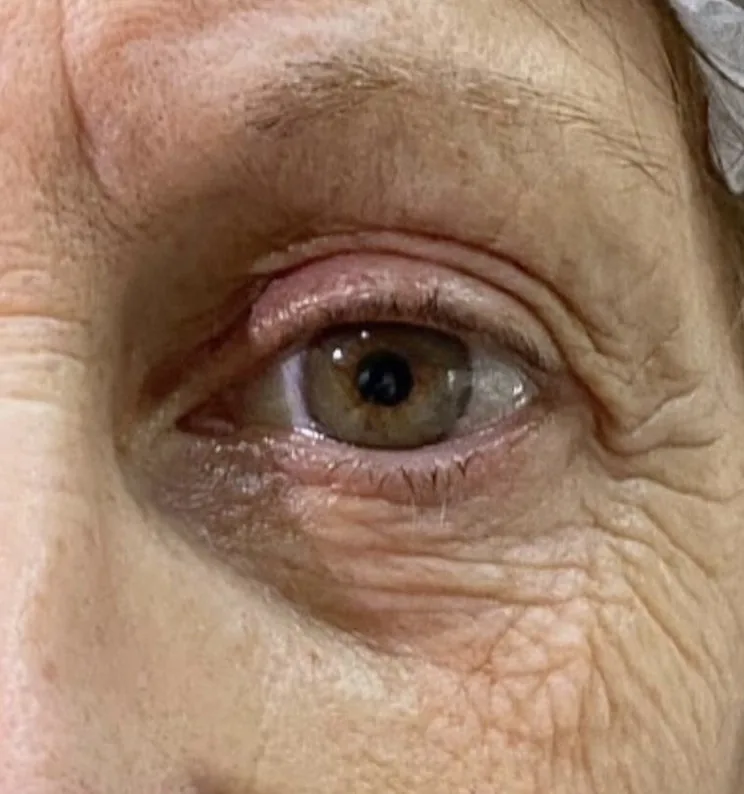Blefaroplastia sin cirugía — caso real 3 — antes