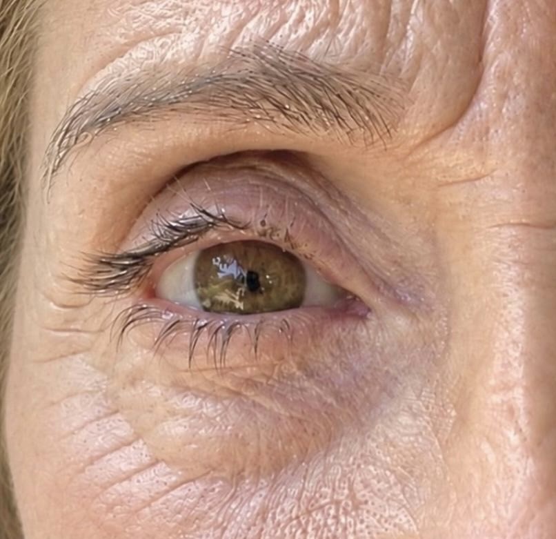 Blefaroplastia sin cirugía — caso real — antes