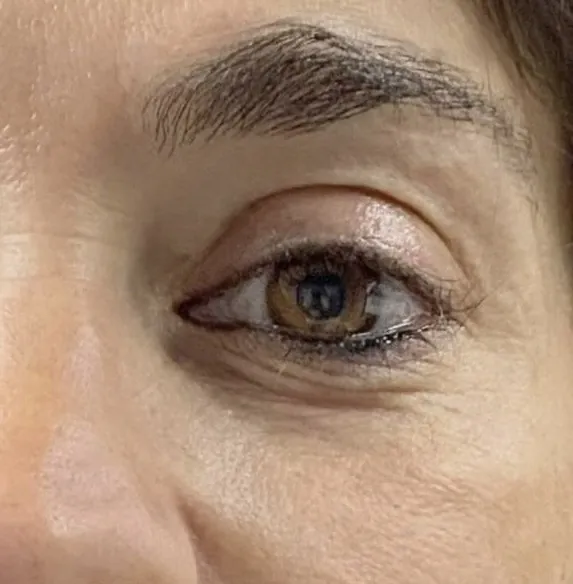 Blefaroplastia sin cirugía — caso real 2 — antes