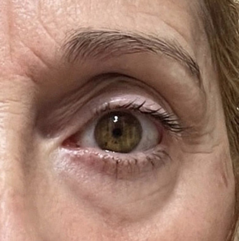 Blefaroplastia sin cirugía — caso real — después