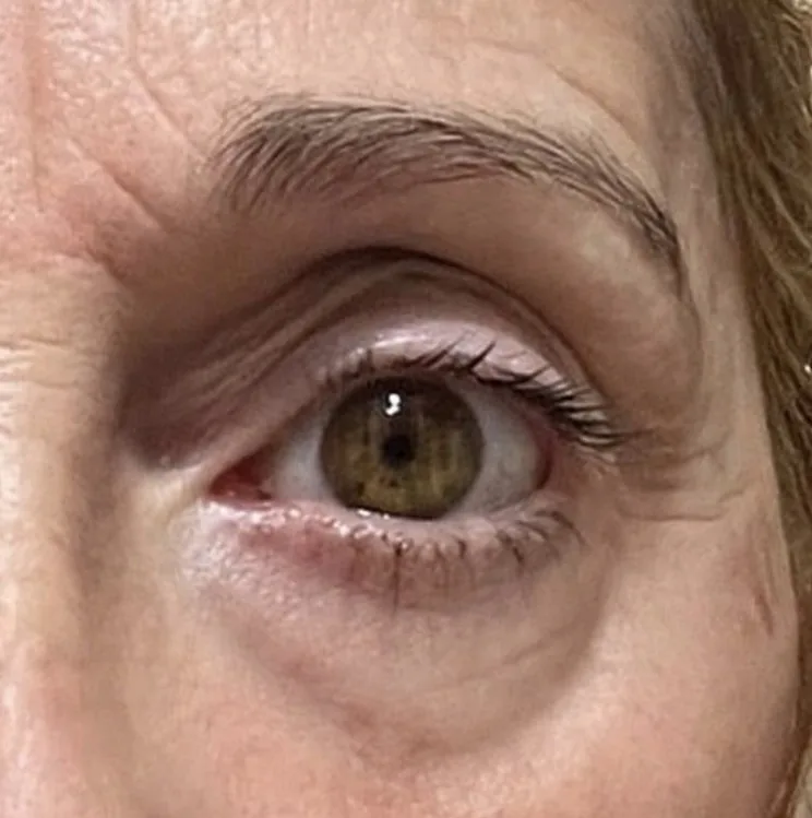 Blefaroplastia sin cirugía — caso real — después