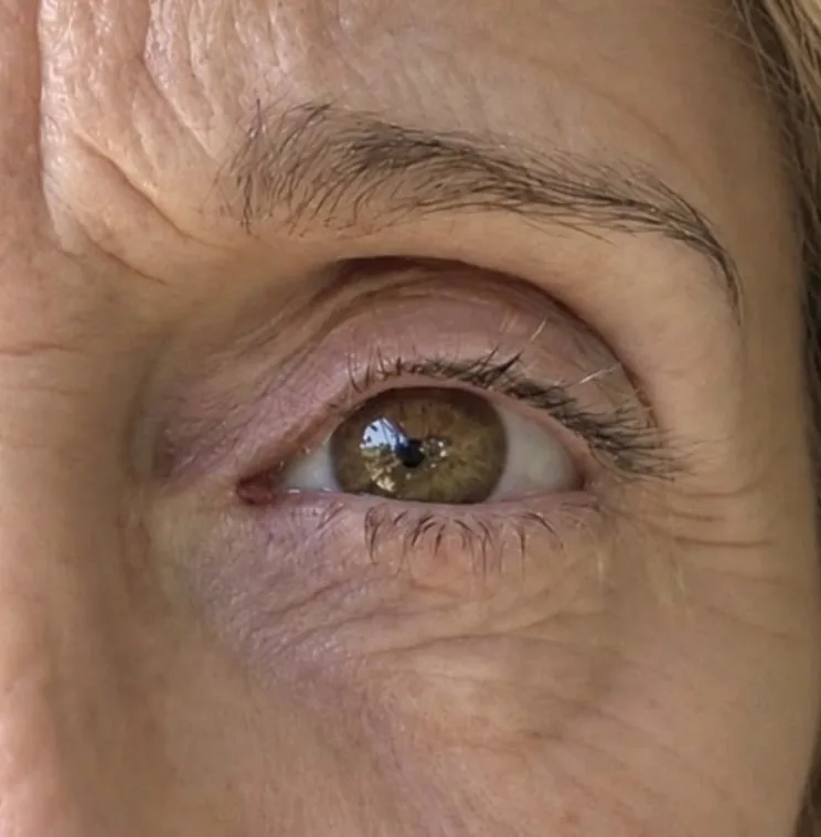 Blefaroplastia sin cirugía — caso real — antes