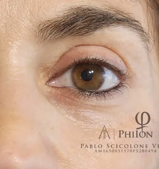 Blefaroplastia sin cirugía — caso real 2 — después
