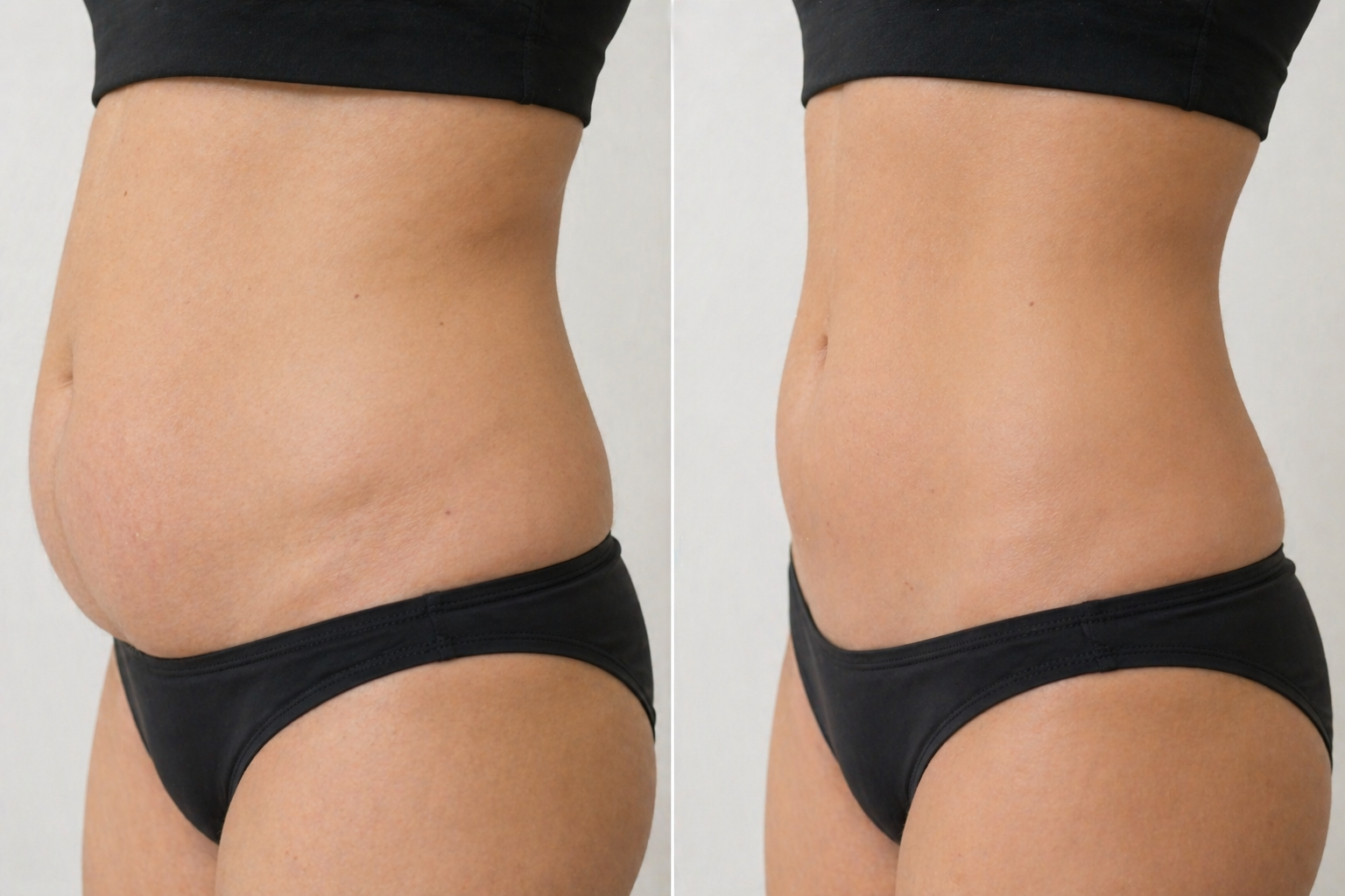 Remodelación corporal 360