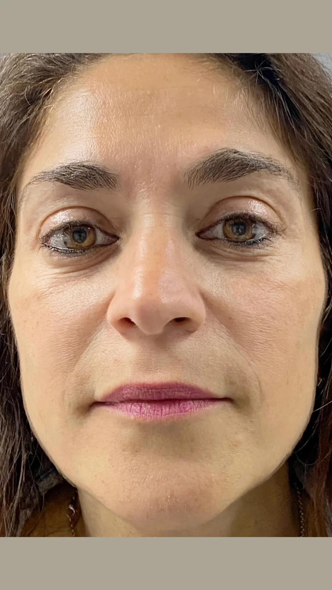 Lifting sin cirugía — caso real 1 — antes