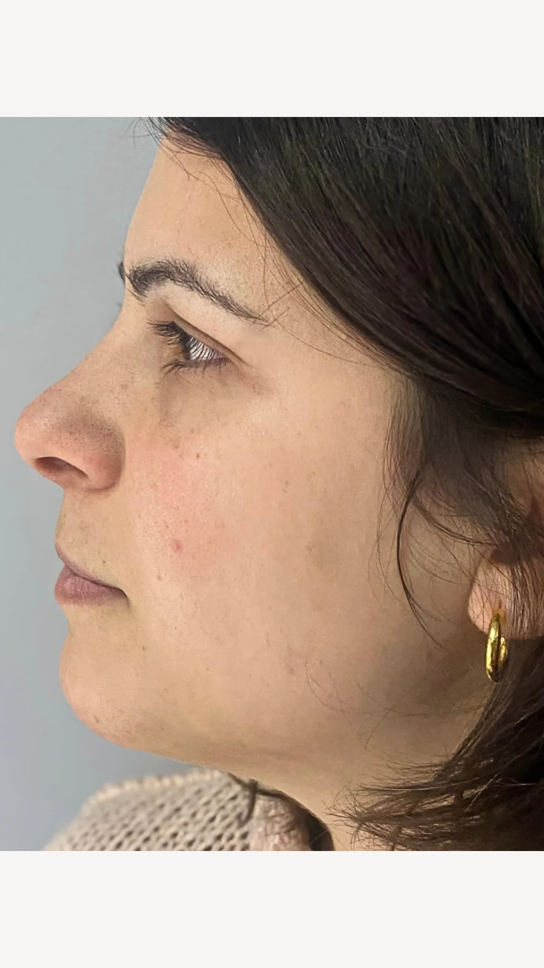 Lifting sin cirugía — caso real 2 — antes