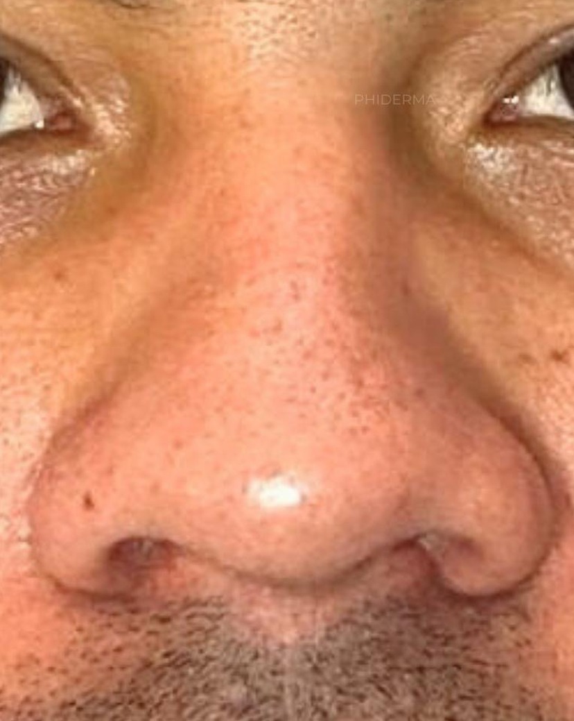 Rinoplastia sin cirugía — caso real - antes