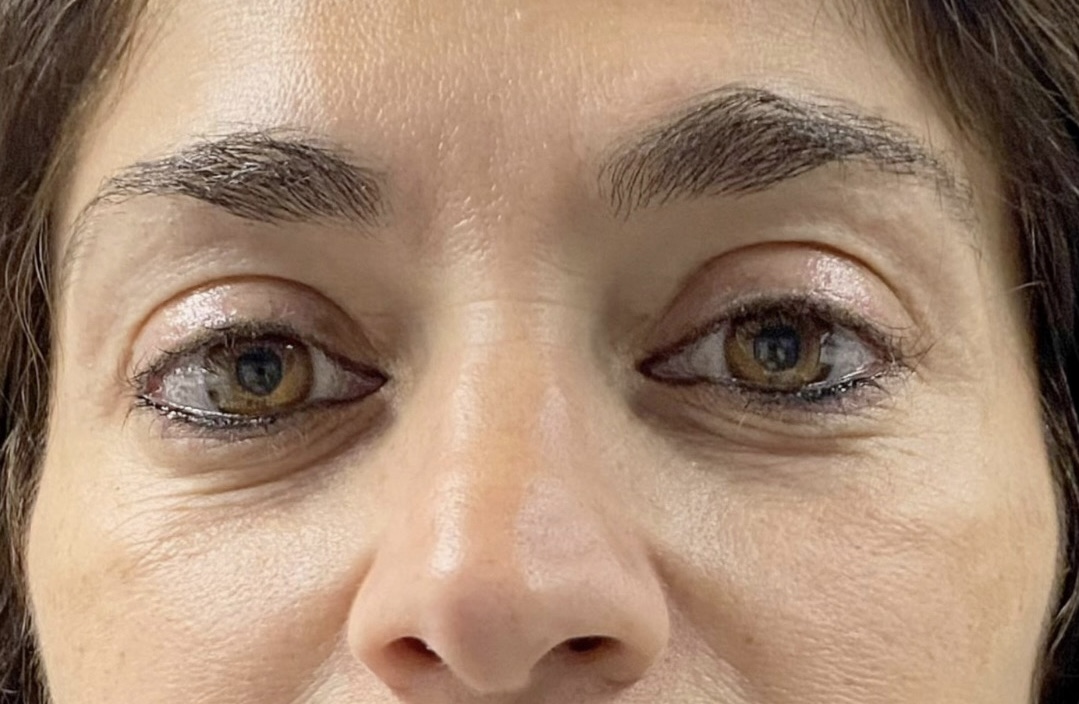 Blefaroplastia sin cirugía — caso real 2 - antes