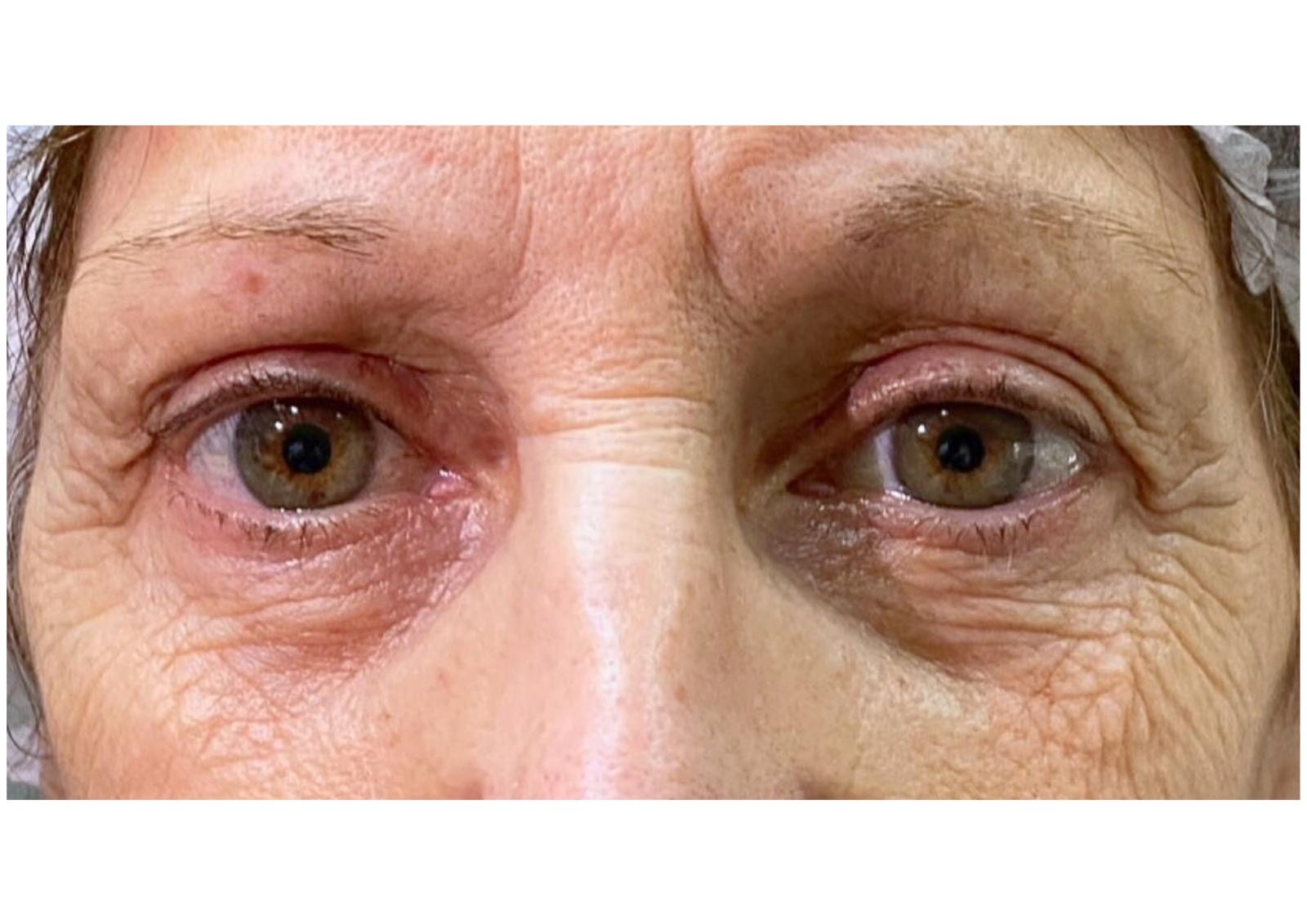 Blefaroplastia sin cirugía — caso real 3 - antes