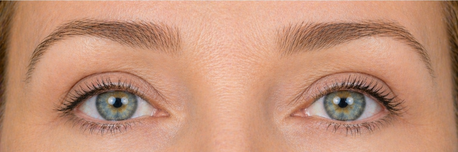 Blefaroplastia sin cirugía — caso real - después