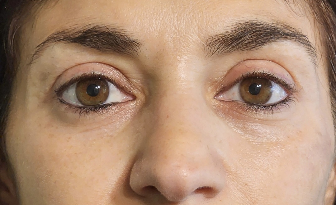Blefaroplastia sin cirugía — caso real 2 - después