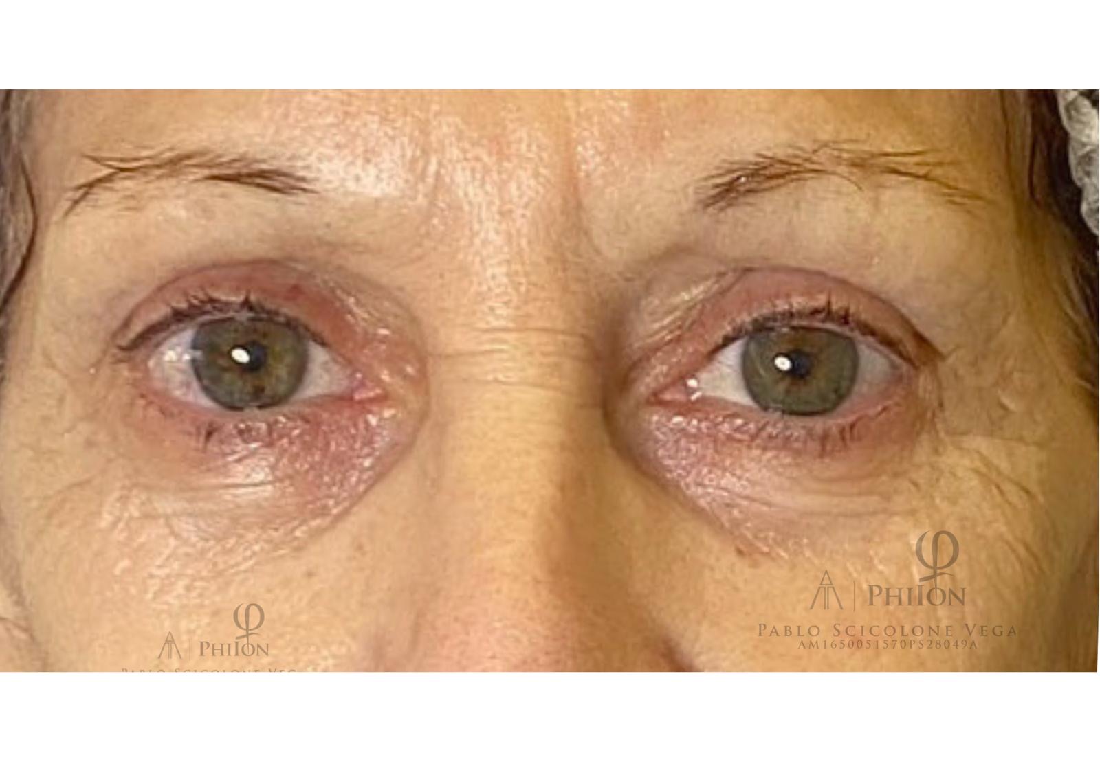 Blefaroplastia sin cirugía — caso real 3 - después